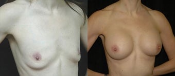 46 year old woman treated with Breast Augmentation before 2990408