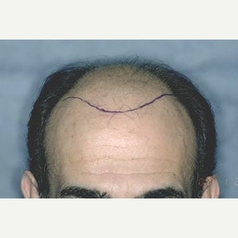 Norwood Class 6 / 4,037 Follicular Unit Grafts / Two Hair Restoration Sessions / Detail of Hairline before 1586636