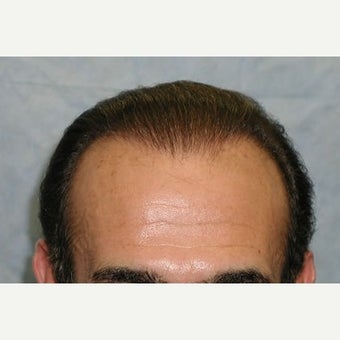 Norwood Class 6 / 4,037 Follicular Unit Grafts / Two Hair Restoration Sessions / Detail of Hairline after 1586636