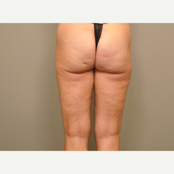 25-34 year old woman treated with Cellfina before 3453602