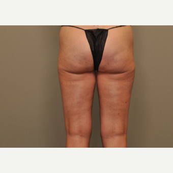 25-34 year old woman treated with Cellfina after 3453602