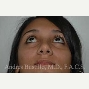 20 year old woman treated with Rhinoplasty after 3462348