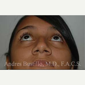 20 year old woman treated with Rhinoplasty before 3462348