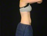 27 y/o female - CoolSculpting 1390353