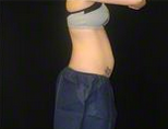 27 y/o female - CoolSculpting 1390353