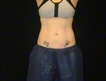 27 y/o female - CoolSculpting after 1390353