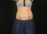 27 y/o female - CoolSculpting before 1390353