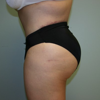 Brazilian Butt Lift after 3667627