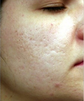18-24 year old woman treated with eMatrix before 1639773