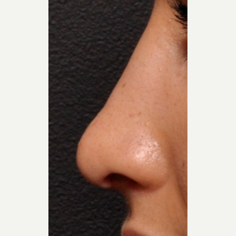 Close Up Detail of Rhinoplasty Result after 2993911