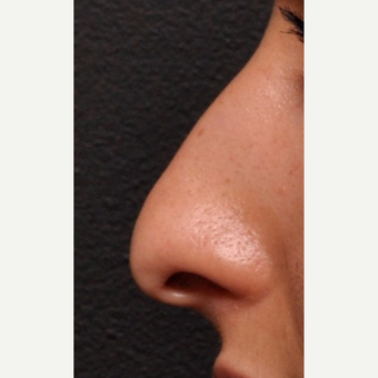Close Up Detail of Rhinoplasty Result before 2993911
