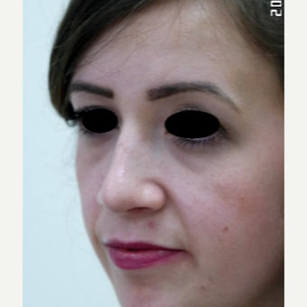 25-34 year old woman treated with Rhinoplasty after 3642931