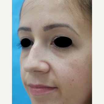 25-34 year old woman treated with Rhinoplasty before 3642931
