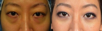 Before and After Bilateral Lower Blepharoplasty Surgery before 1017582