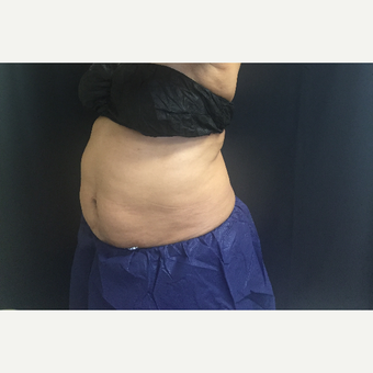 65-74 year old woman treated with CoolSculpting before 3390671
