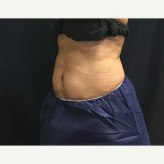65-74 year old woman treated with CoolSculpting after 3390671