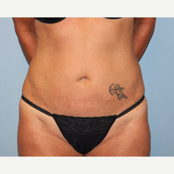 35-44 year old woman treated with Tummy Tuck before 3815697