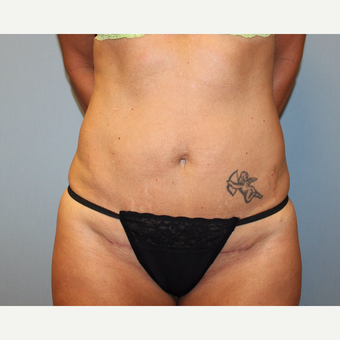 35-44 year old woman treated with Tummy Tuck after 3815697