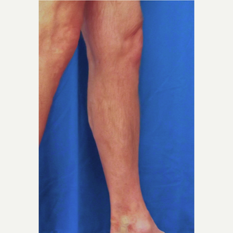 55-64 year old man treated with Vein Treatment after 3093071