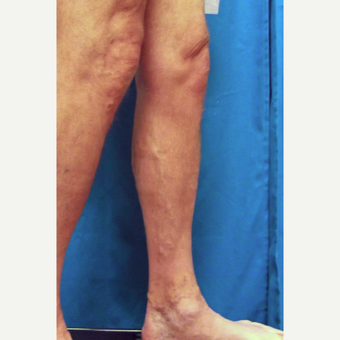 55-64 year old man treated with Vein Treatment before 3093071