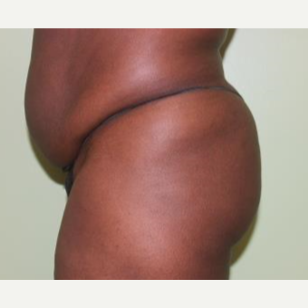 35-44 year old woman treated with Butt Augmentation before 3241594