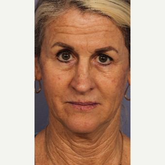 55-64 year old woman treated with Laser Resurfacing before 3658588