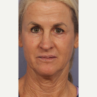 55-64 year old woman treated with Laser Resurfacing after 3658588
