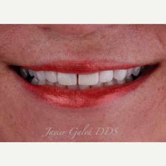 Severely restored teeth treated with Emax Crowns, Veneers and Smile Makeover after 3120107
