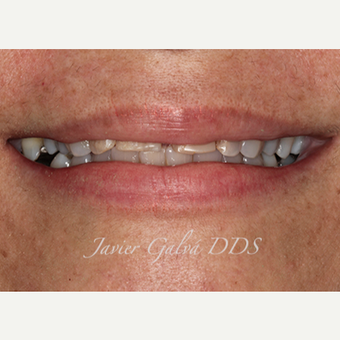 Severely restored teeth treated with Emax Crowns, Veneers and Smile Makeover before 3120107