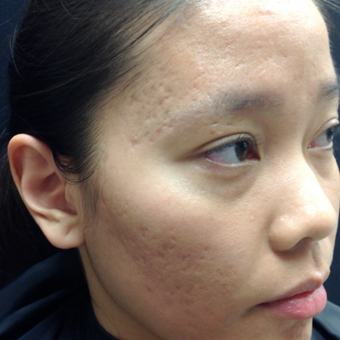 25-34 year old woman treated with Microneedling before 3844400