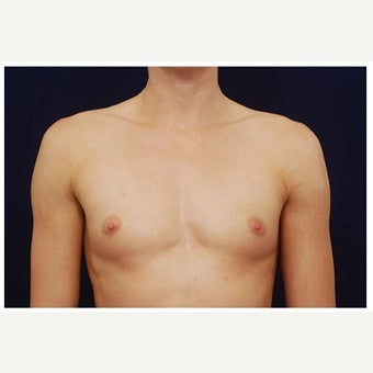 25-34 year old woman treated with Inspira Breast Implants before 1862152