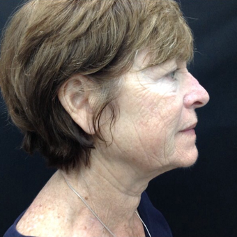 65-74 year old woman treated with Pelleve after 3383165