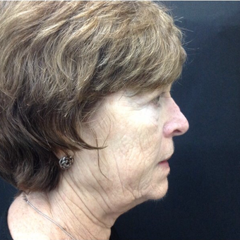 65-74 year old woman treated with Pelleve before 3383165
