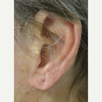 Age 75 and up woman treated with Ear Lobe lift Surgery before 3453098
