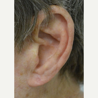 Age 75 and up woman treated with Ear Lobe lift Surgery after 3453098