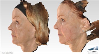 64 year old Voluma Liquid Facelift, 12 syringes 1161556