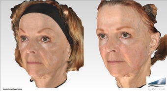 64 year old Voluma Liquid Facelift, 12 syringes before 1161556