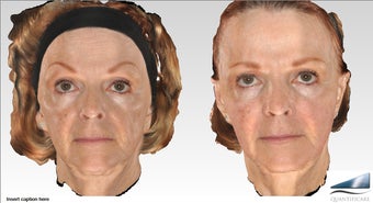 64 year old Voluma Liquid Facelift, 12 syringes after 1161556