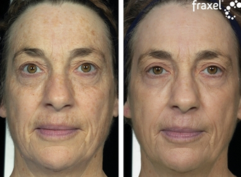 Fraxel for pigmentation and skin laxity before 8530