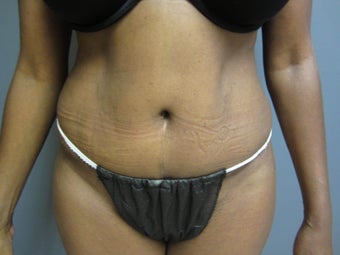53 year old female presents for a tummy tuck after 673132