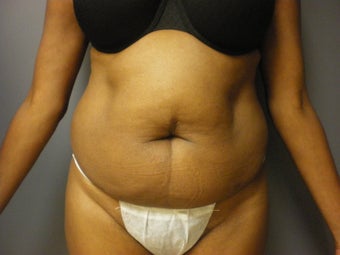 53 year old female presents for a tummy tuck before 673132