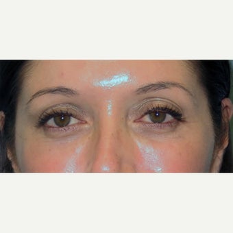 35-44 year old woman treated with Eye Bags Treatment after 2438508