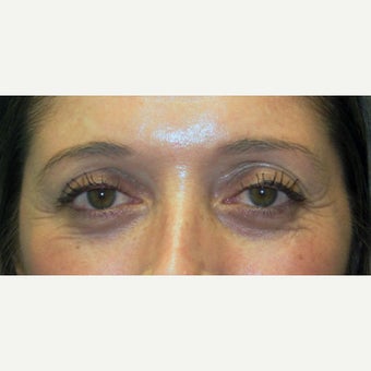 35-44 year old woman treated with Eye Bags Treatment before 2438508