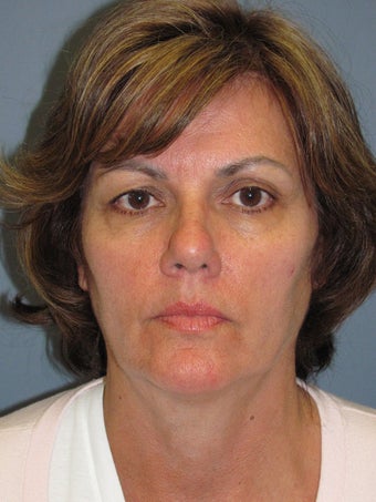 Brow Lift on 52-year-old before 952646
