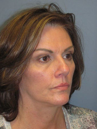Brow Lift on 52-year-old 952646