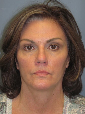 Brow Lift on 52-year-old after 952646