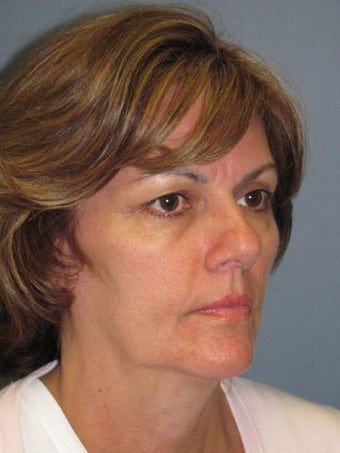 Brow Lift on 52-year-old 952646