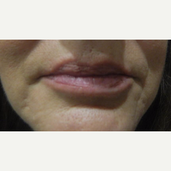45-54 year old woman treated with Volbella before 3703736