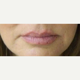 45-54 year old woman treated with Volbella after 3703736