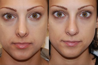 Non-Surgical Nose Job before 213043